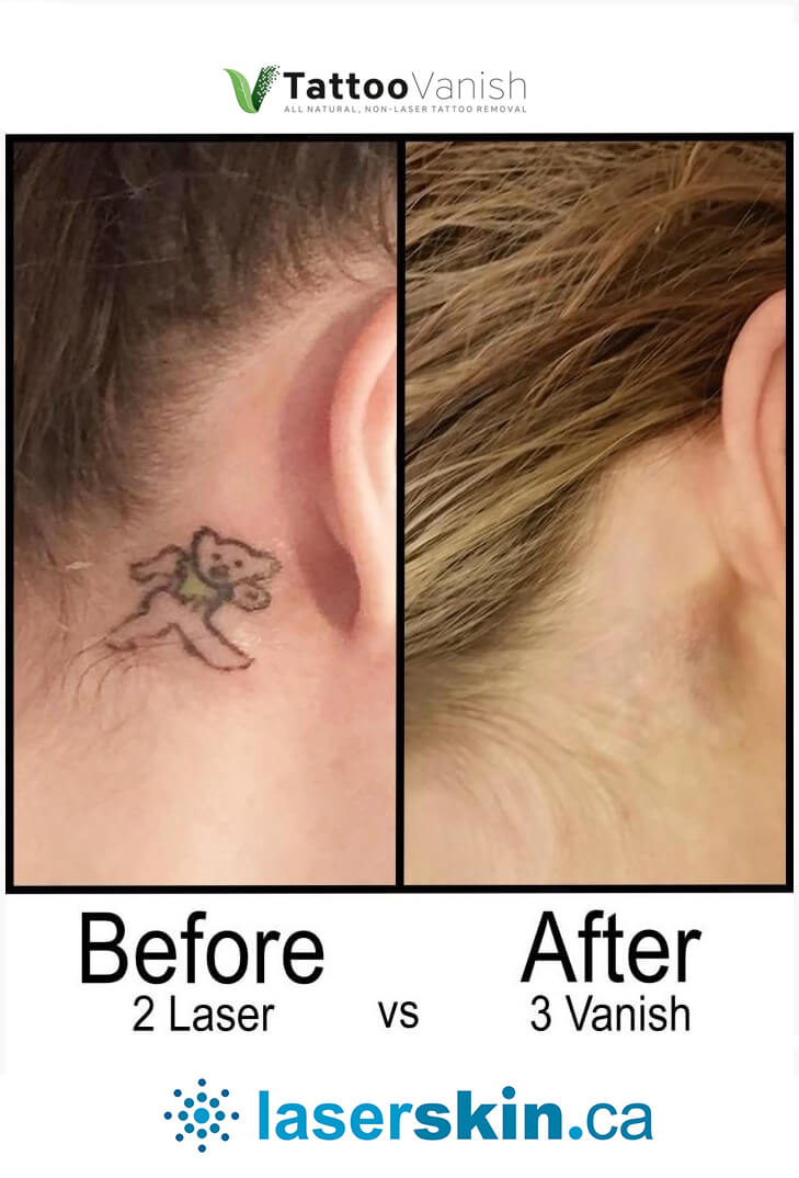 Before and After Tattoo Removal - Get the Best Res (8)
