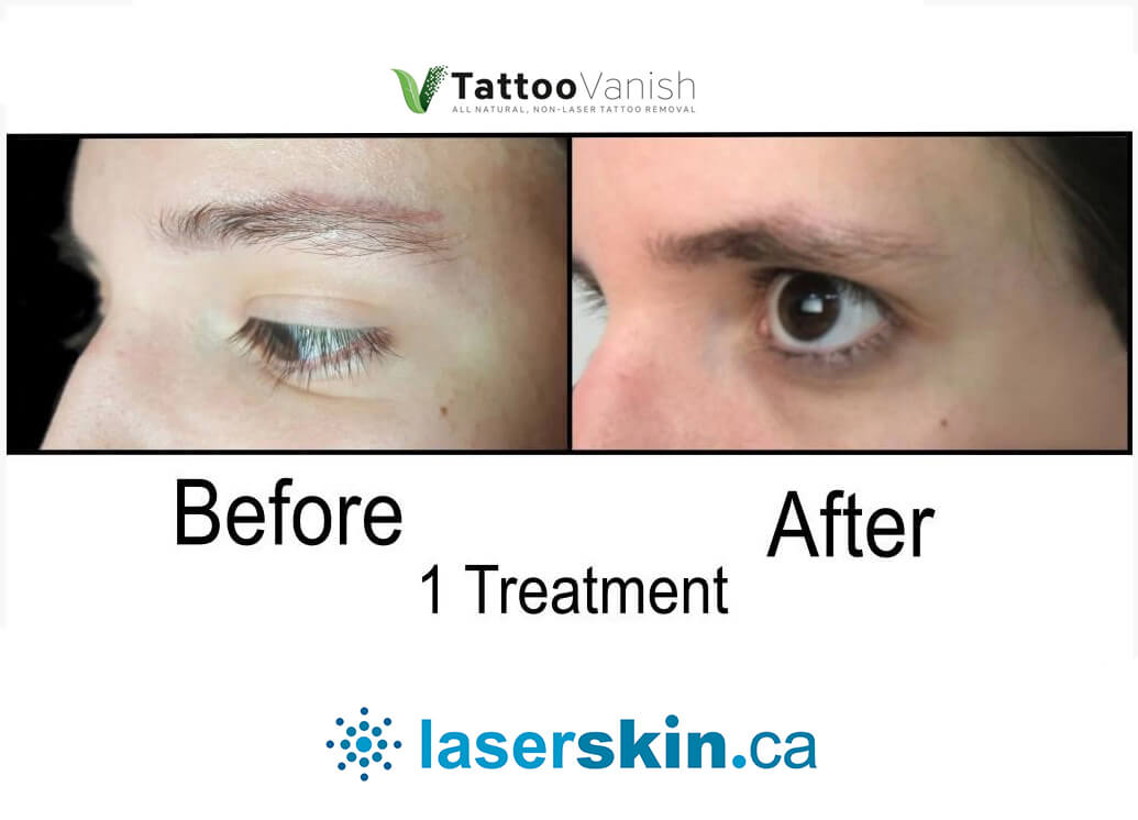 Before and After Tattoo Removal - Get the Best Res (9)