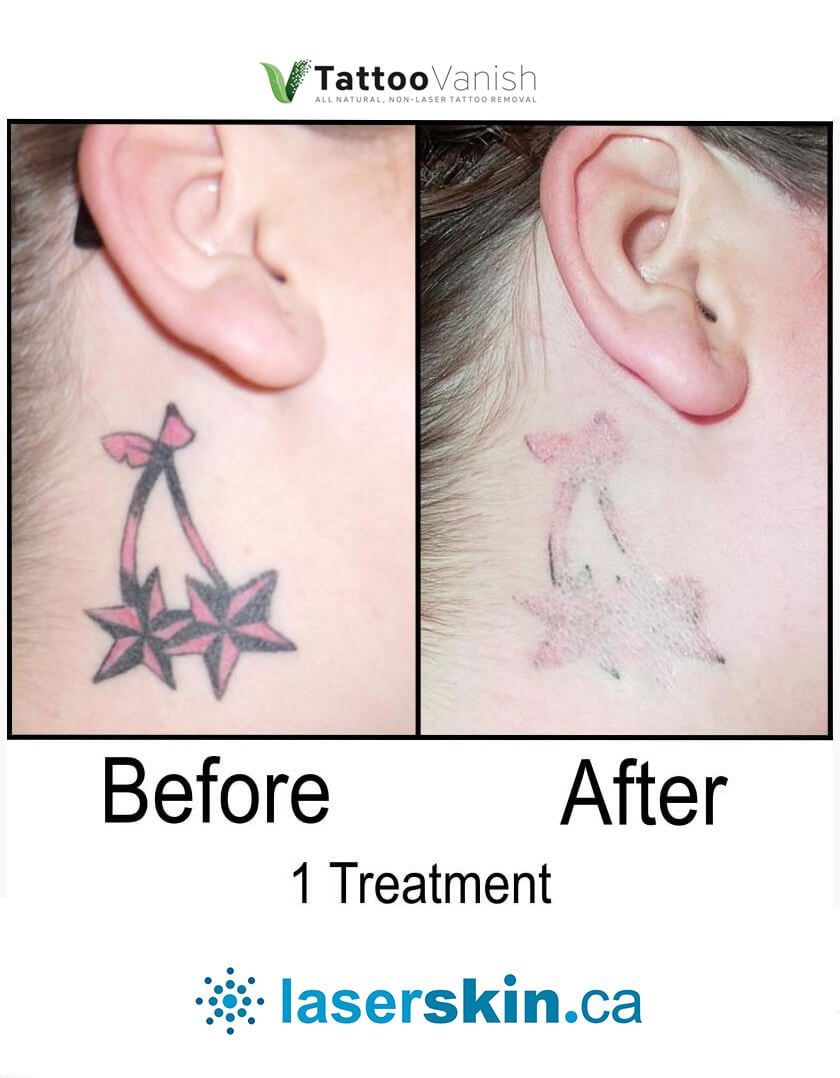 Before and After Tattoo Removal - Get the Best Res