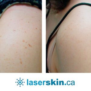 Laser Vein Removal Edmonton  Spider Vein and Telangiectasia