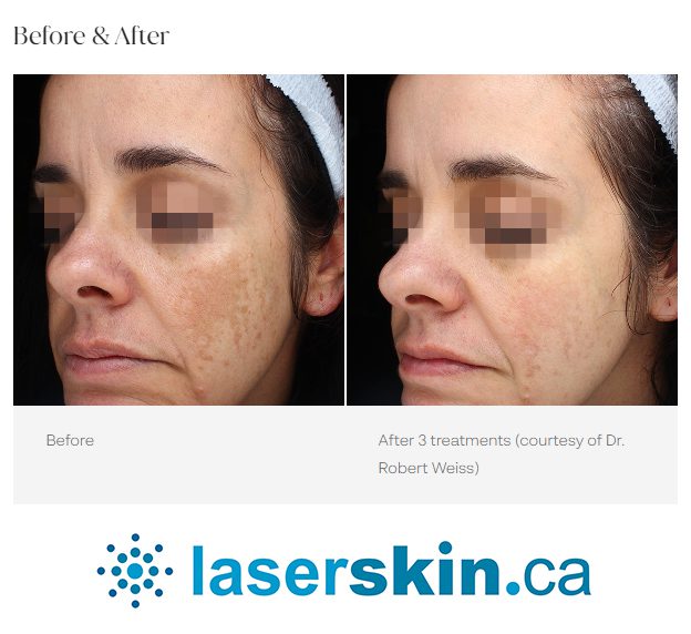 melasma before and after