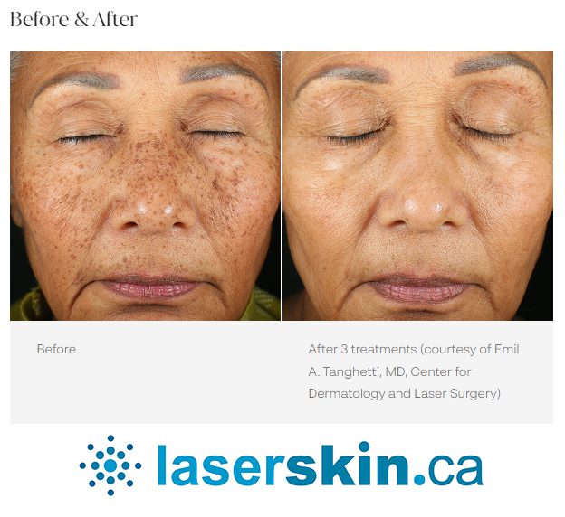 melasma before and after