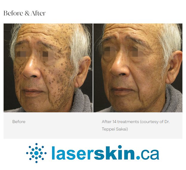 melasma before and after