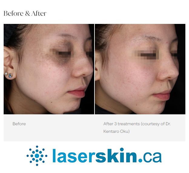 melasma before and after