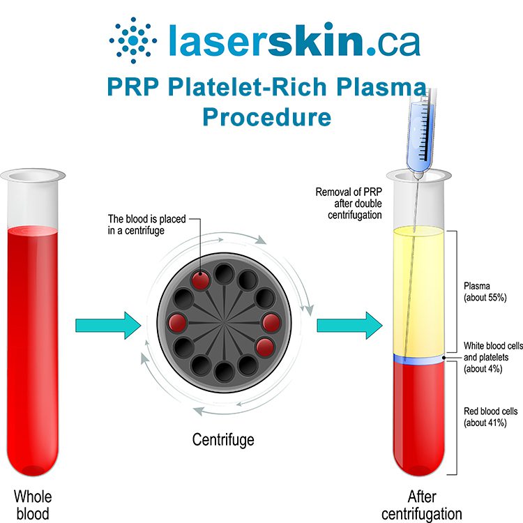 PRP Platelet-rich plasma procedure