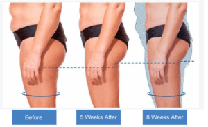 body contouring before and afer