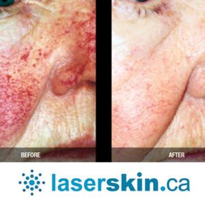 rosacea removal