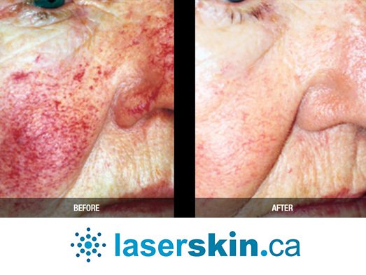 rosacea removal