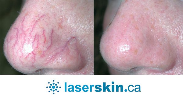 Varicose Vein Laser & IPL Vascular Treatment Toronto