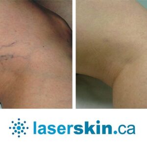 spider vein removal