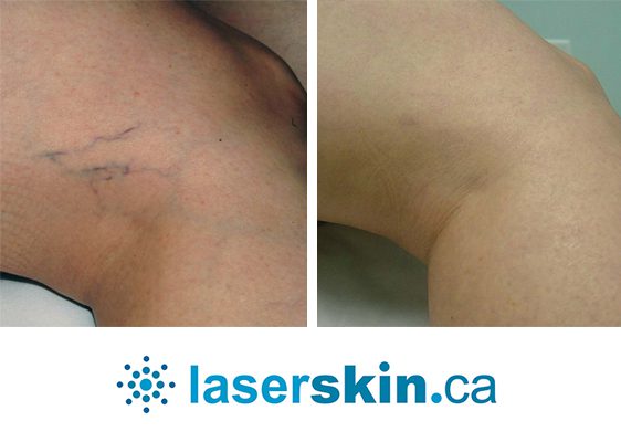 spider vein removal