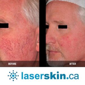 rosacea removal