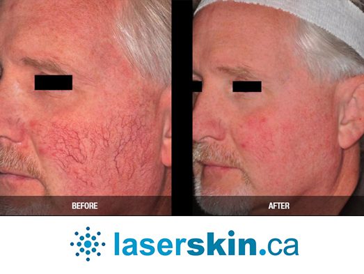 rosacea removal