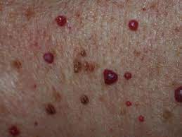 cherry angioma