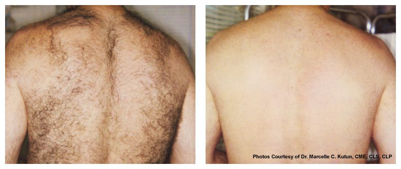 laser hair removal before and after