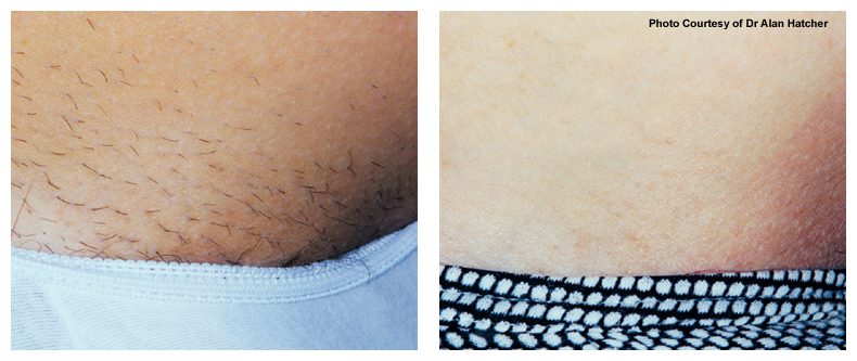 laser hair removal before and after