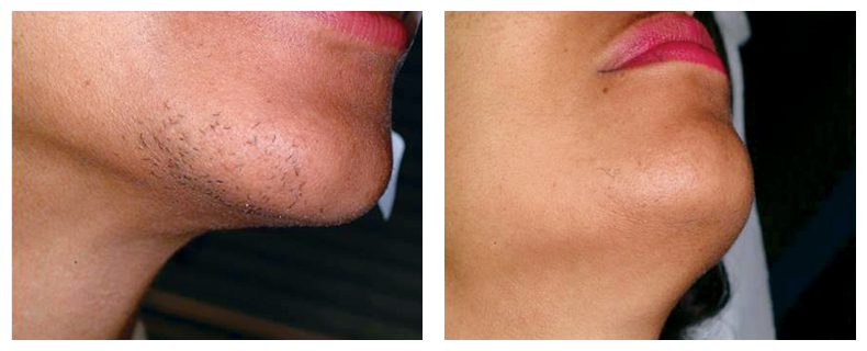 laser hair removal before and after