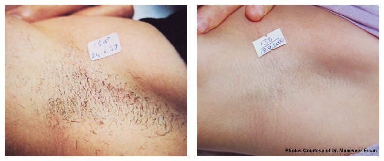 laser hair removal before and after