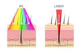 ipl vs laser hair removal