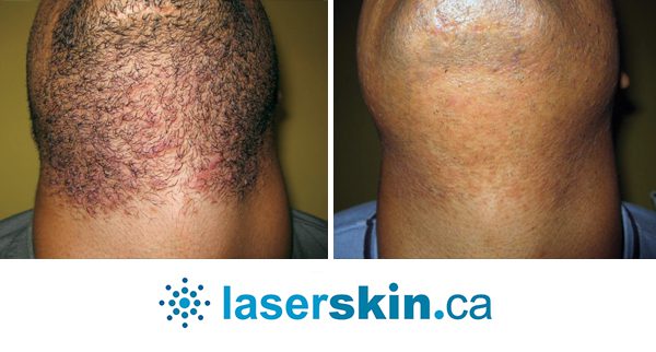 LASER vs IPL Hair Removal, which is better?