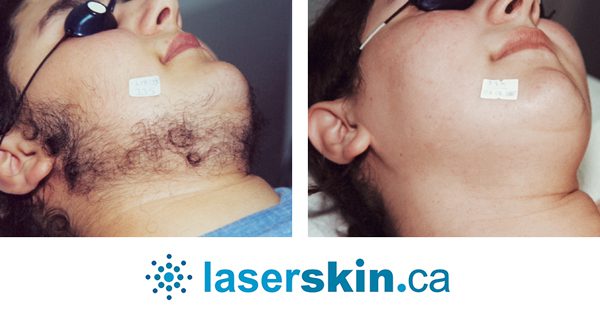 laser-hair-removal-2