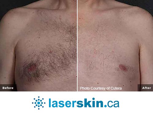 laser-hair-removal-3