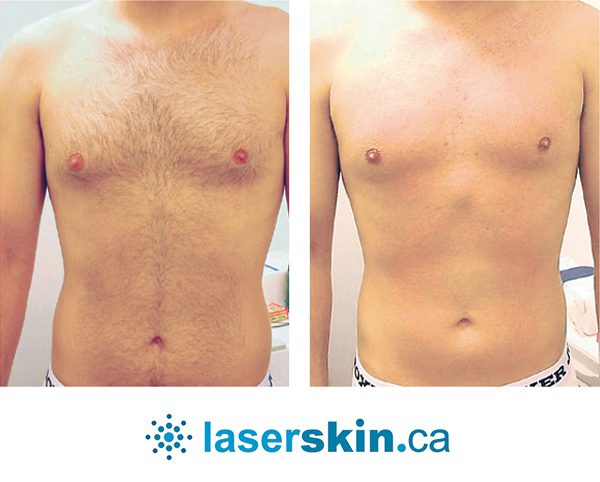 laser-hair-removal-5