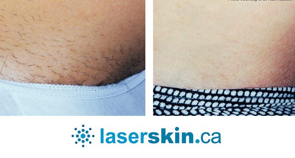 laser-hair-removal-7