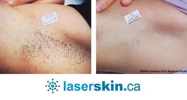 laser-hair-removal-9