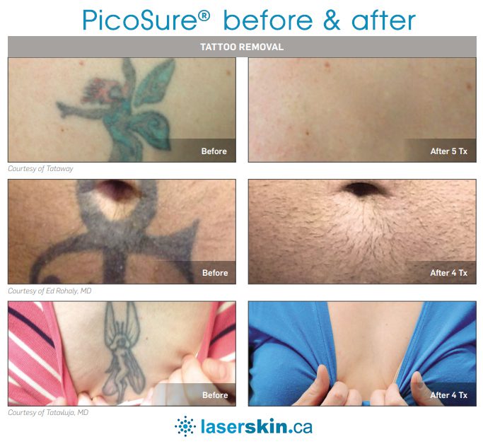 laser tattoo removal toronto