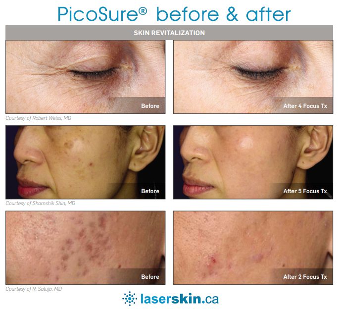 picosure laser skin treatments
