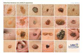 seborrheic keratoses - warts