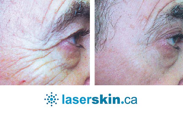 laser skin rejuvenation