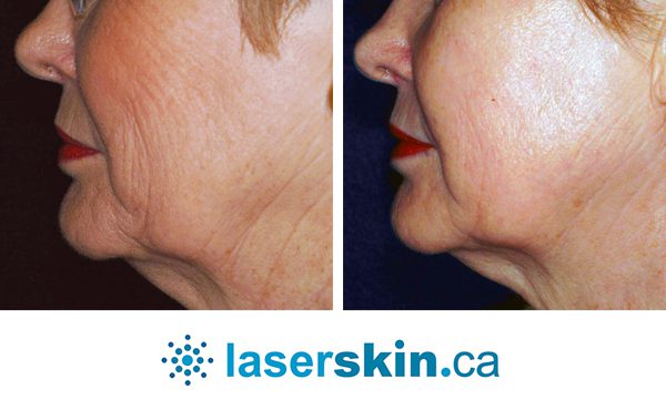 laser skin rejuvenation