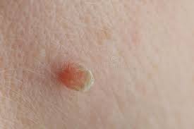 dermatofibromas (Skin Tags)