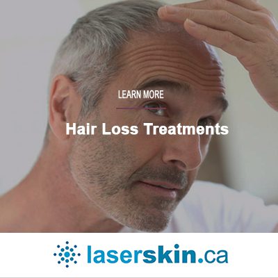 square header - hair loss treatment