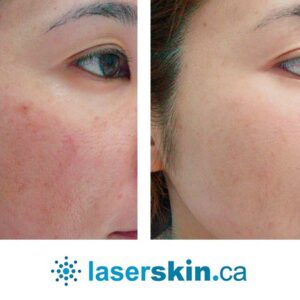 rosacea removal