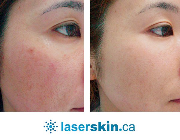 rosacea removal