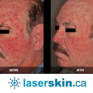 rosacea removal