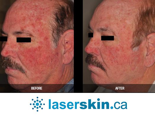 rosacea removal