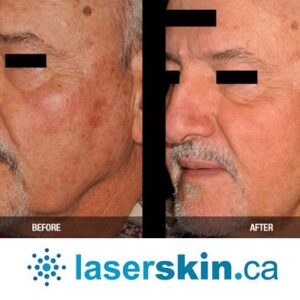 rosacea removal