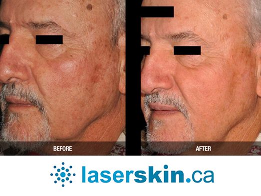 rosacea removal