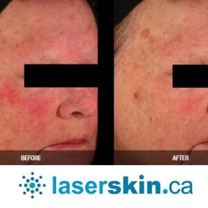 rosacea removal