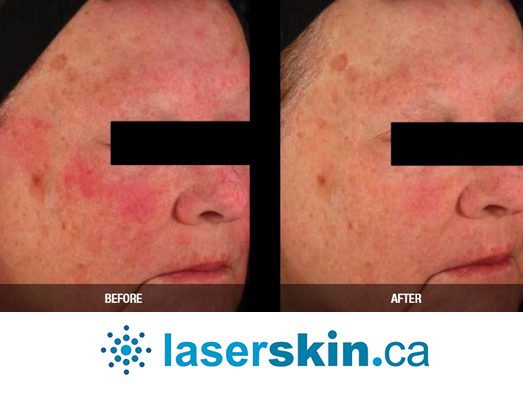 rosacea removal