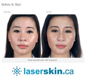 Derma filler before and after with Aquamid