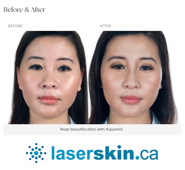 Derma filler before and after with Aquamid