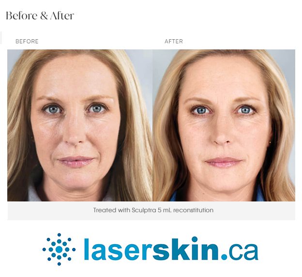 derma filler before and after with Sculptra
