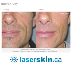 derma filler before and after with Bellafill
