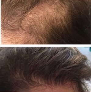 laserskin.ca-hair loss program