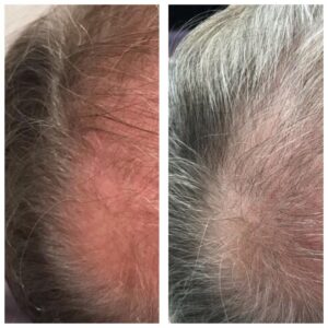laserskin.ca-hair loss program